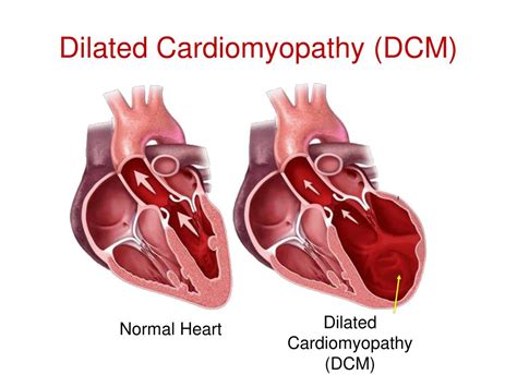 Gedilateerde Cardiomyopathie (DCM) .